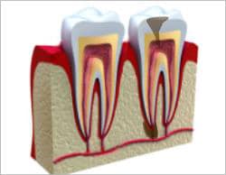  Endodontic Treatments
